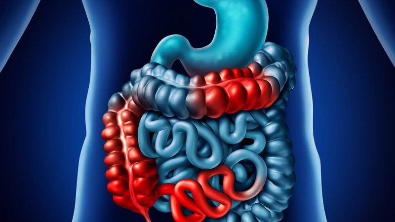 بیماری التهابی روده با رژیم غذایی FODMAP درمان می شود؟