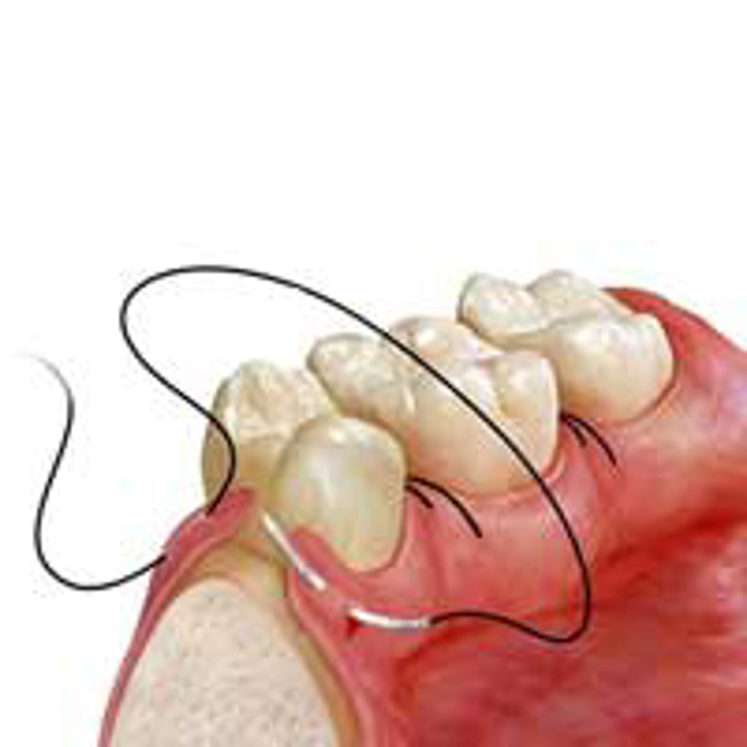 نخ بخیه جراحی دندانپزشکی