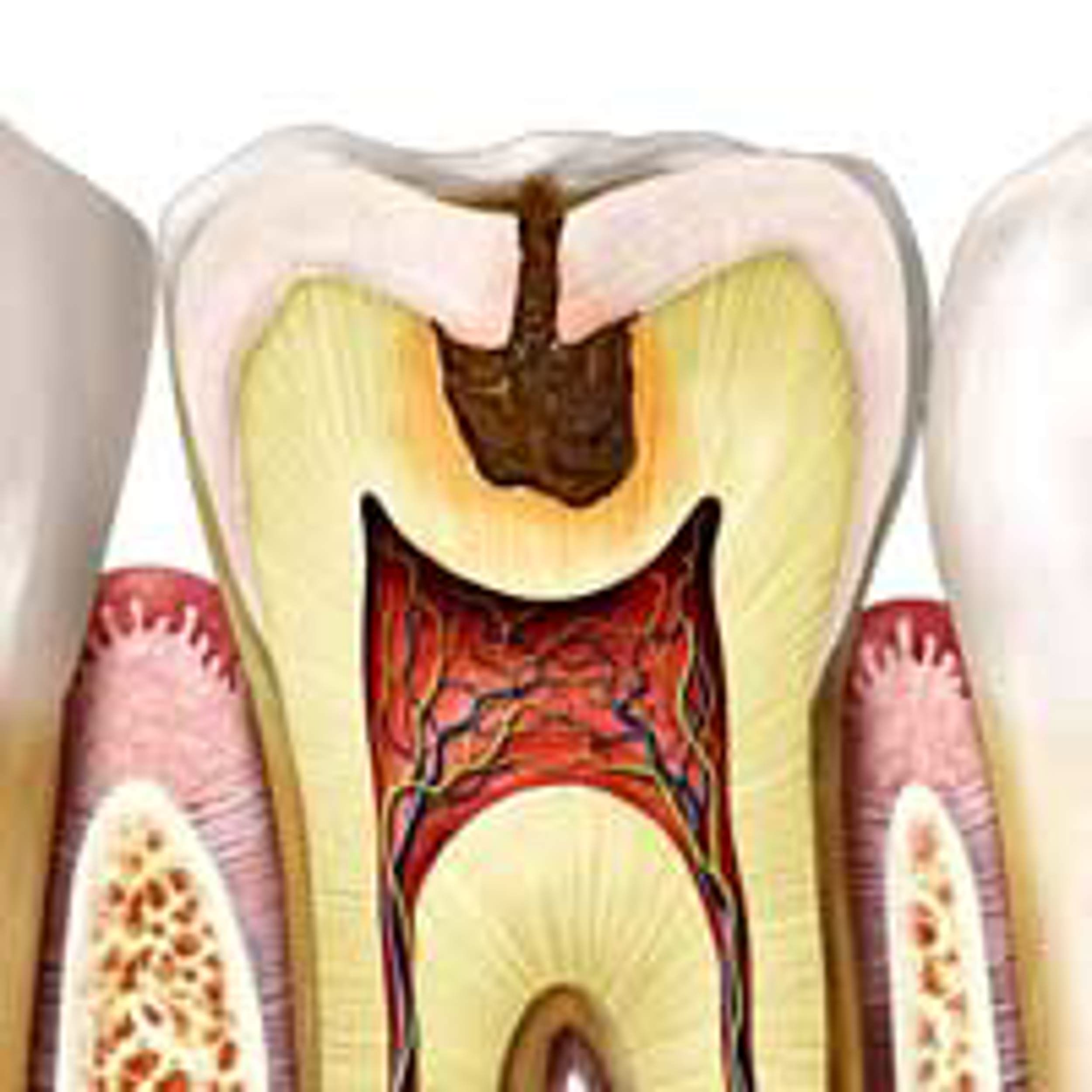 تشخیص پوسیدگی