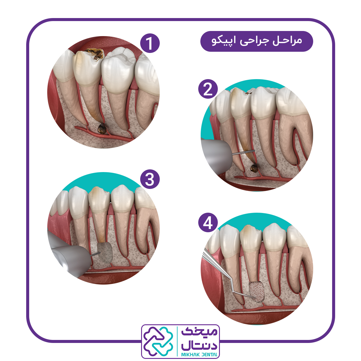 نحوه جراحی اپیکو