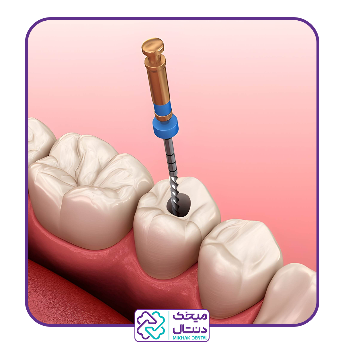 عصب کشی دندان