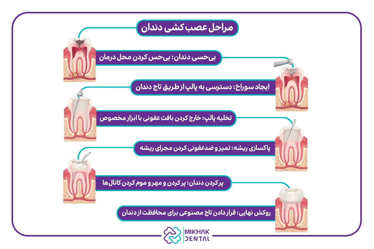 مراحل عصب کشی دندان