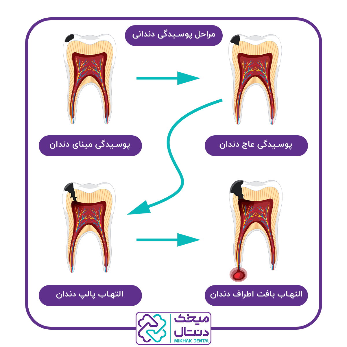 مراحل پوسیدگی دندان