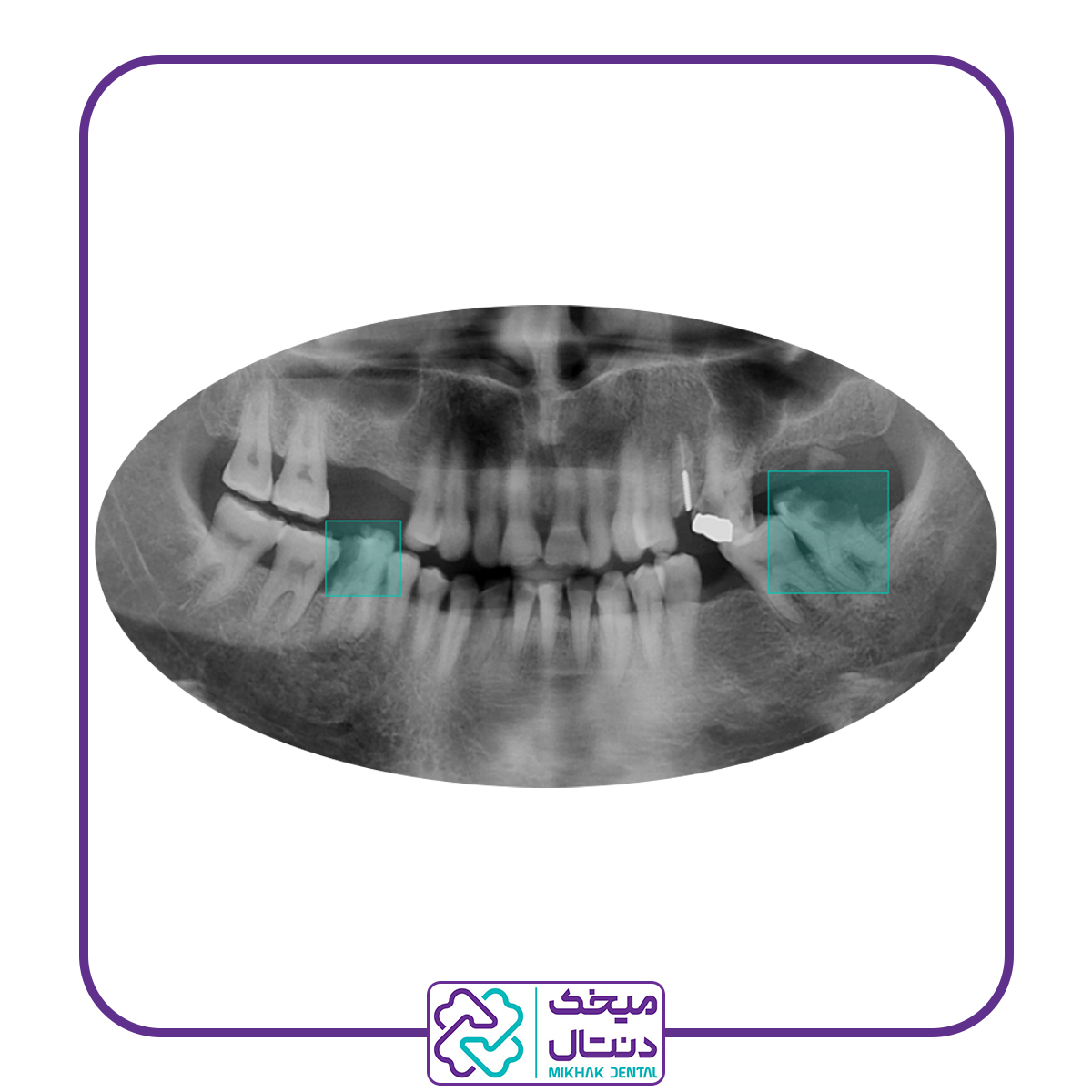 انواع درمان ریشه