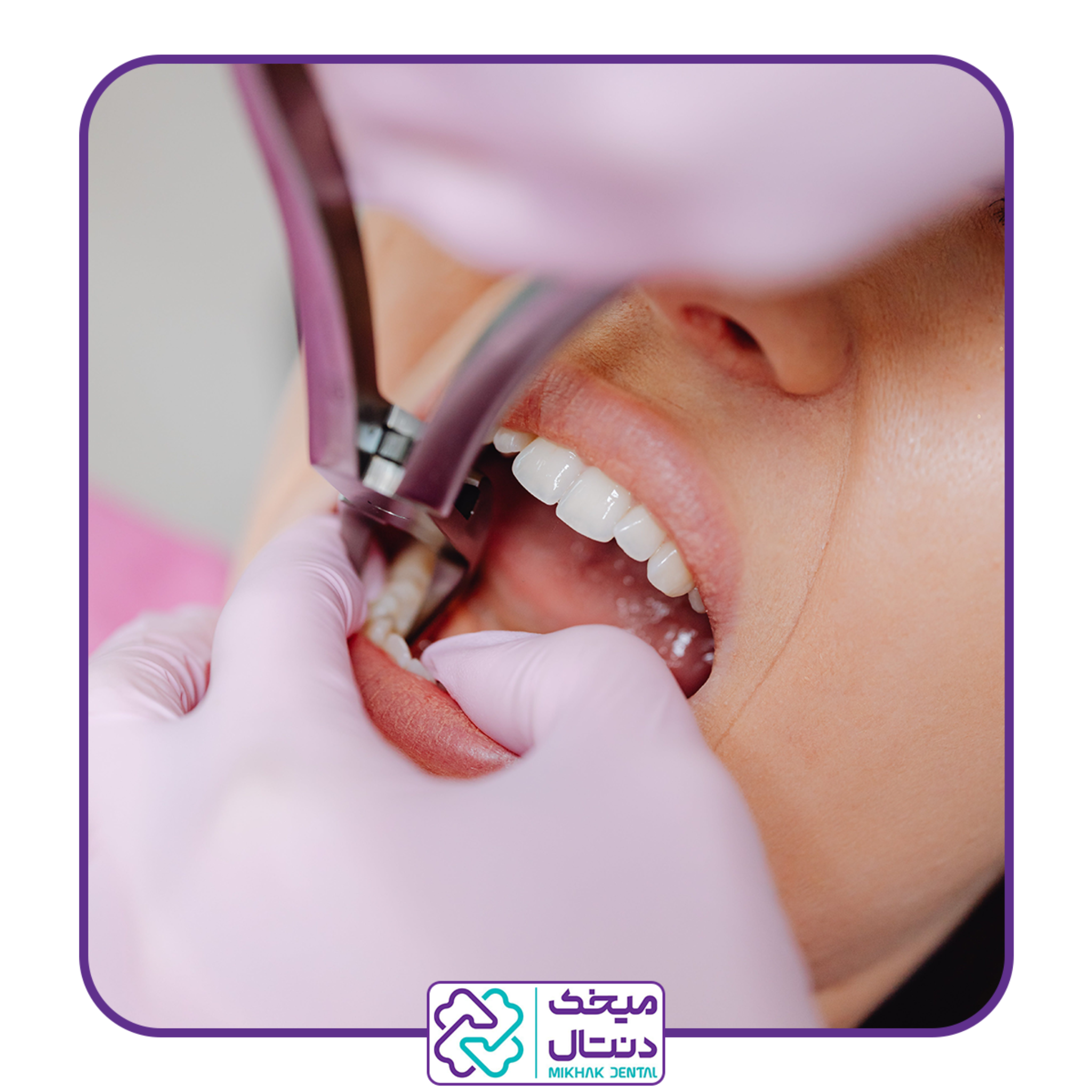 کشیدن دندان