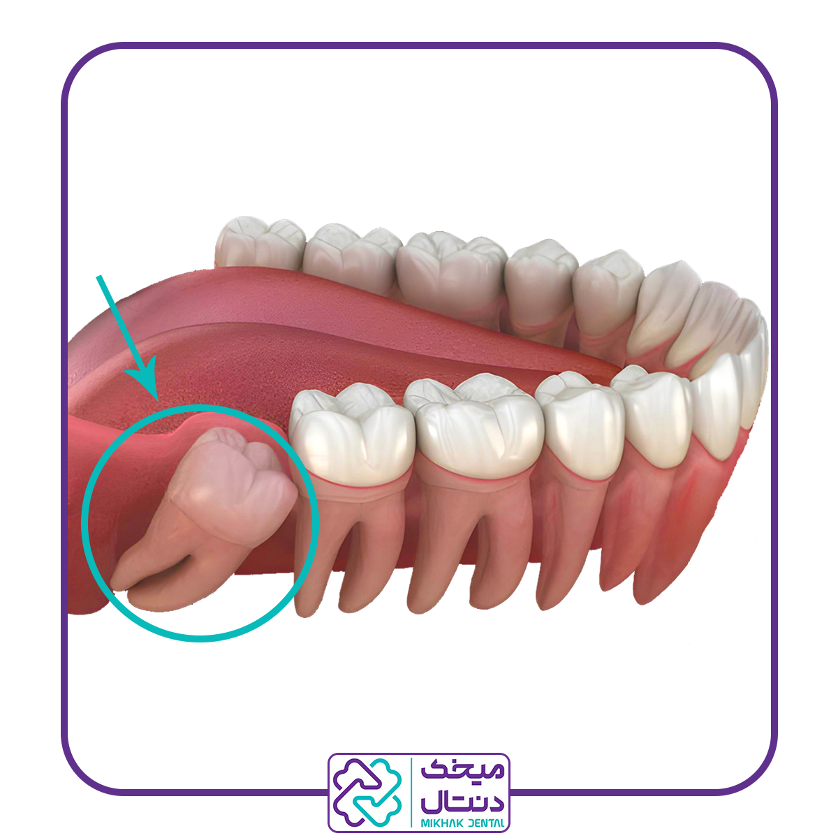 جراحی دندان عقل