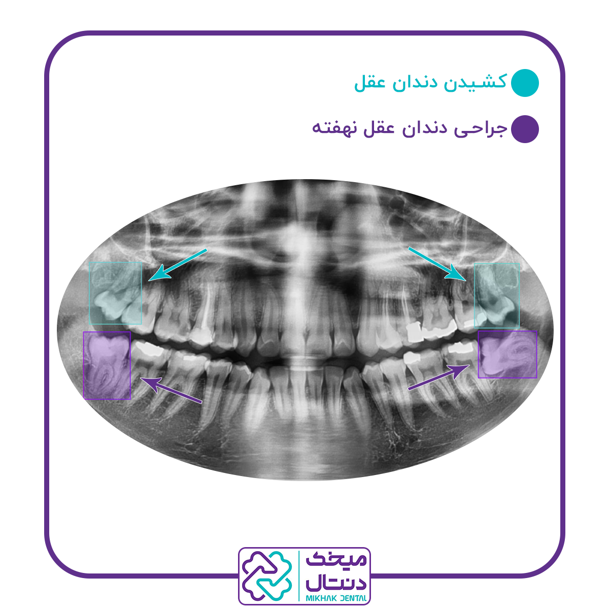 کشیدن و جراحی دندان عقل