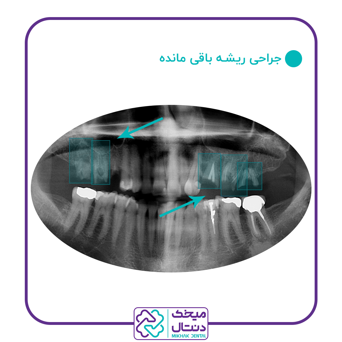 جراحی ریشه دندان