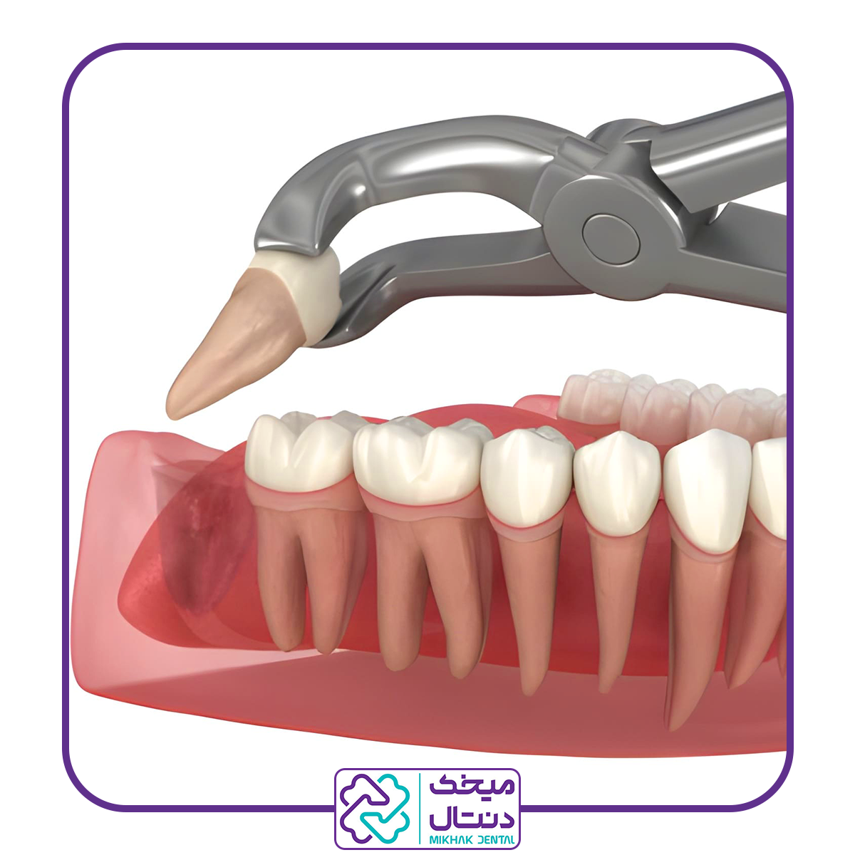 کشیدن دندان عقل