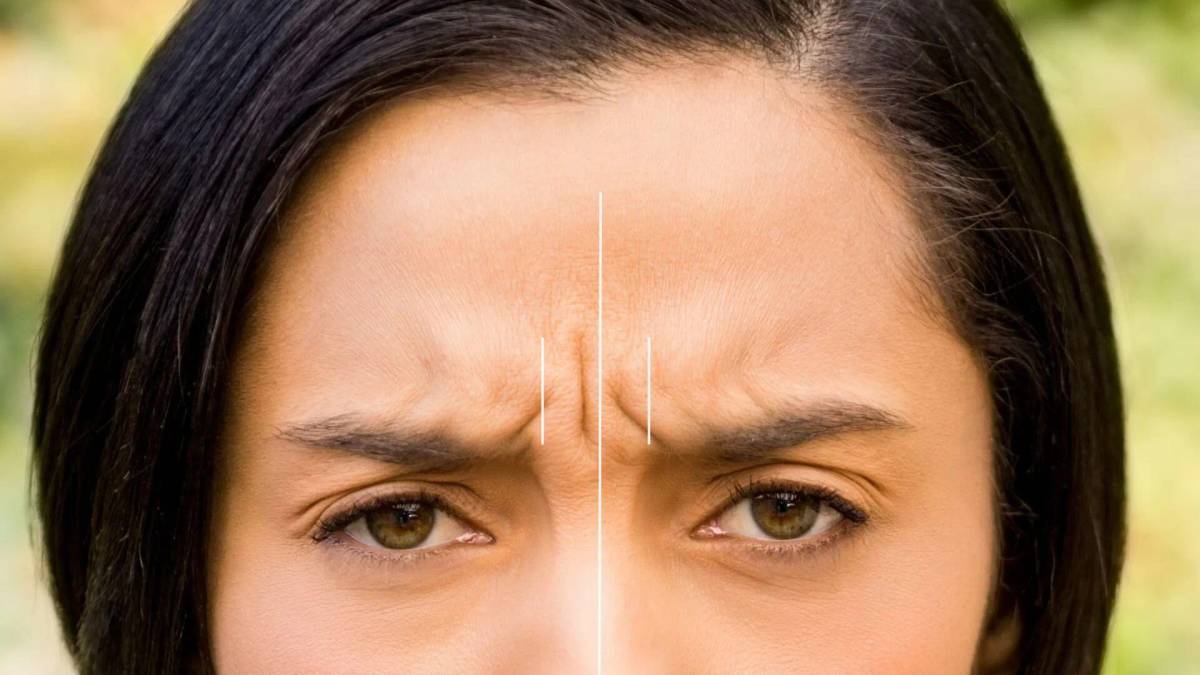 تزریق بوتاکس خط اخم (Glabella)؛ خداحافظی با خطوط ۱۱ و چهره عصبانی